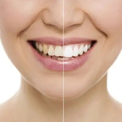 5 Points Nails & Spa - Teeth Whitening